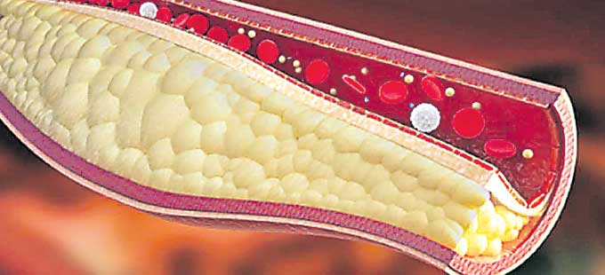 కొలెస్ట్రాల్‌ తగ్గించుకోవాలా? - Vimarsana News