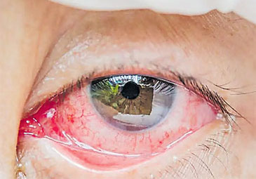 Eye Bleeding Virus: ఫ్రాన్స్‌లో కాంగో వైరస్‌ కలవరం.. సోకితే కళ్లలో తీవ్ర రక్తస్రావం